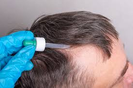 Top 10 Minoxidil Cream Manufacturers In India